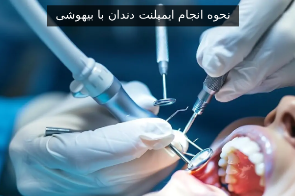 نحوه انجام ایمپلنت دندان با بیهوشی