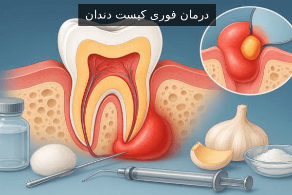 درمان فوری کیست دندان