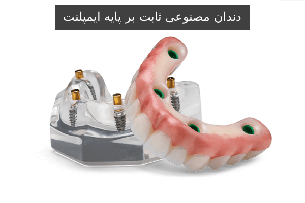 دندان مصنوعی ثابت بر پایه ایمپلنت