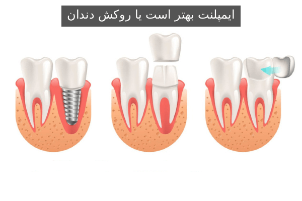 ایمپلنت بهتر است یا روکش دندان