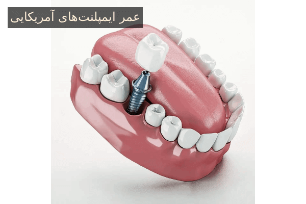 عمر ایمپلنت‌های آمریکایی