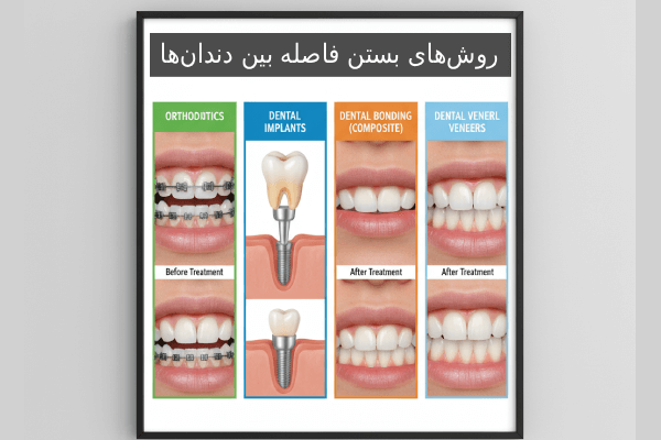 روشهای بستن فاصله بین دندانها