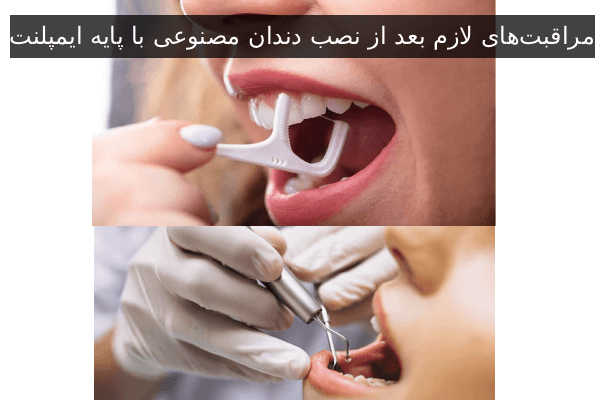مراقبتهای لازم بعد از نصب دندان مصنوعی با پایه ایمپلنت