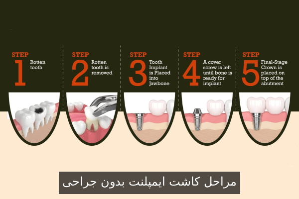 مراحل کاشت ایمپلنت بدون جراحی