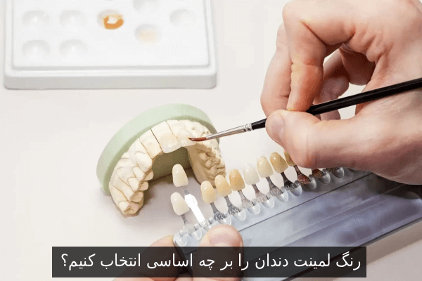 رنگ لمینت دندان را بر چه اساسی انتخاب کنیم؟