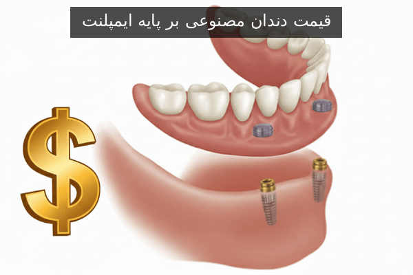 قیمت دندان مصنوعی بر پایه ایمپلنت
