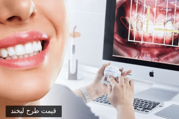 قیمت طرح لبخند
