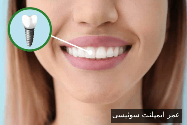 عمر ایمپلنت سوئیسی