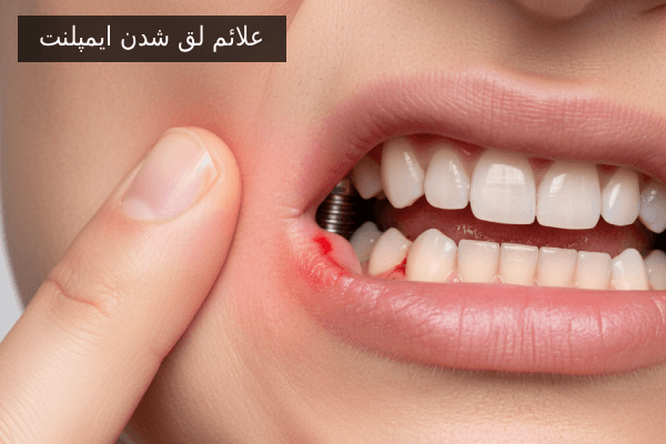 علائم لق شدن ایمپلنت