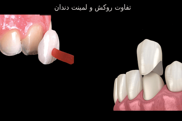 تفاوت روکش و لمینت دندان