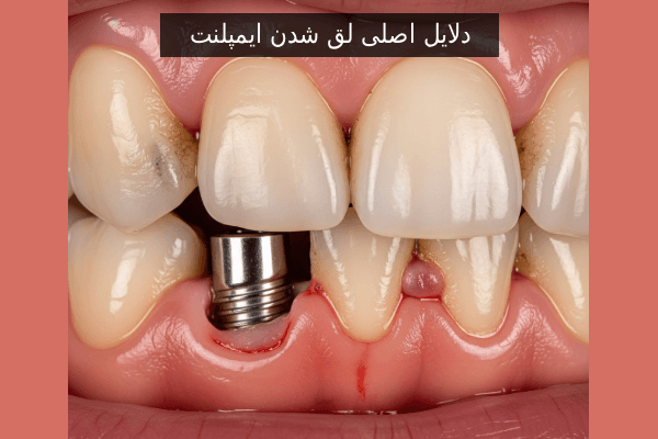 دلایل اصلی لق شدن ایمپلنت