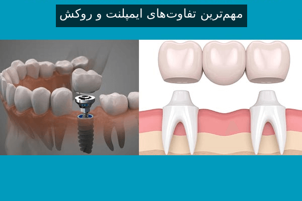 مهم‌ترین تفاوت‌های ایمپلنت و روکش