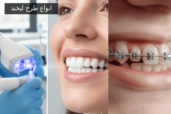 انواع طرح لبخند