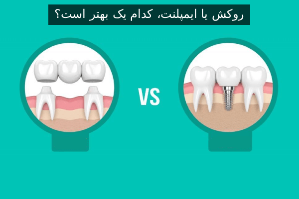 روکش یا ایمپلنت، کدام یک بهتر است؟