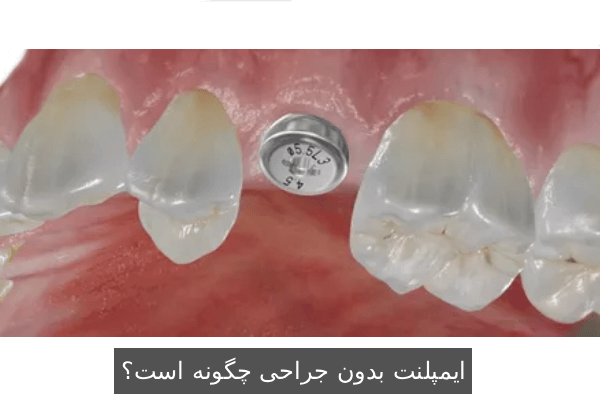 ایمپلنت بدون جراحی چگونه است؟