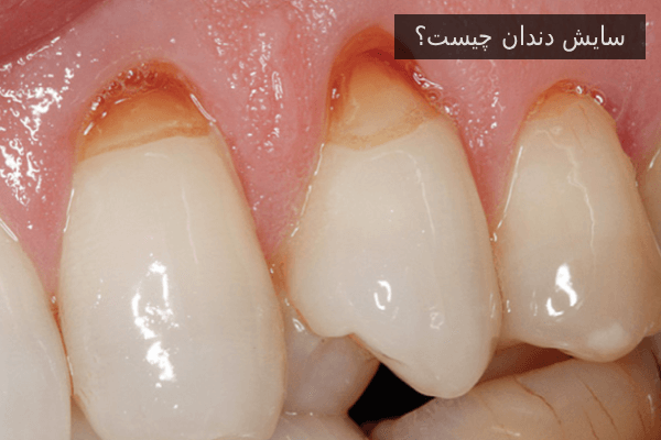 سایش دندان چیست؟