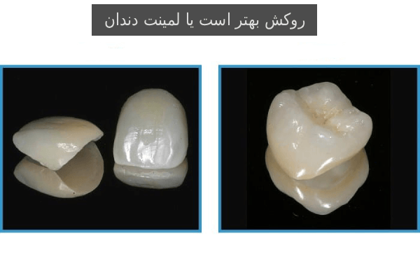 روکش بهتر است یا لمینت دندان